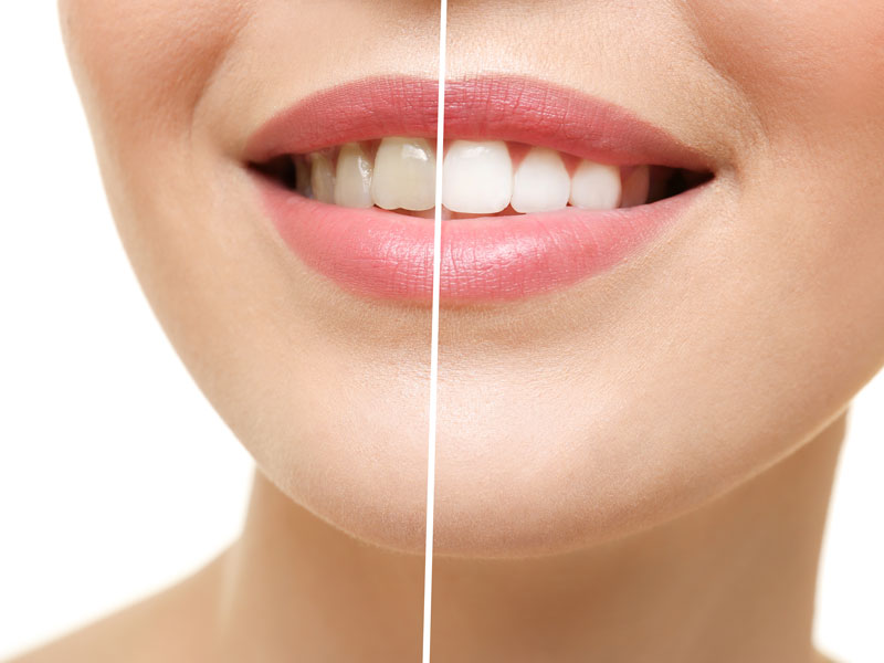 Whitening